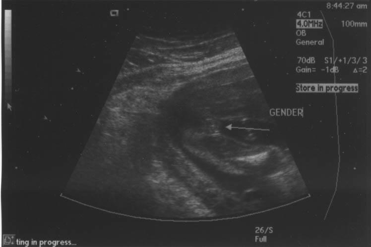 gender